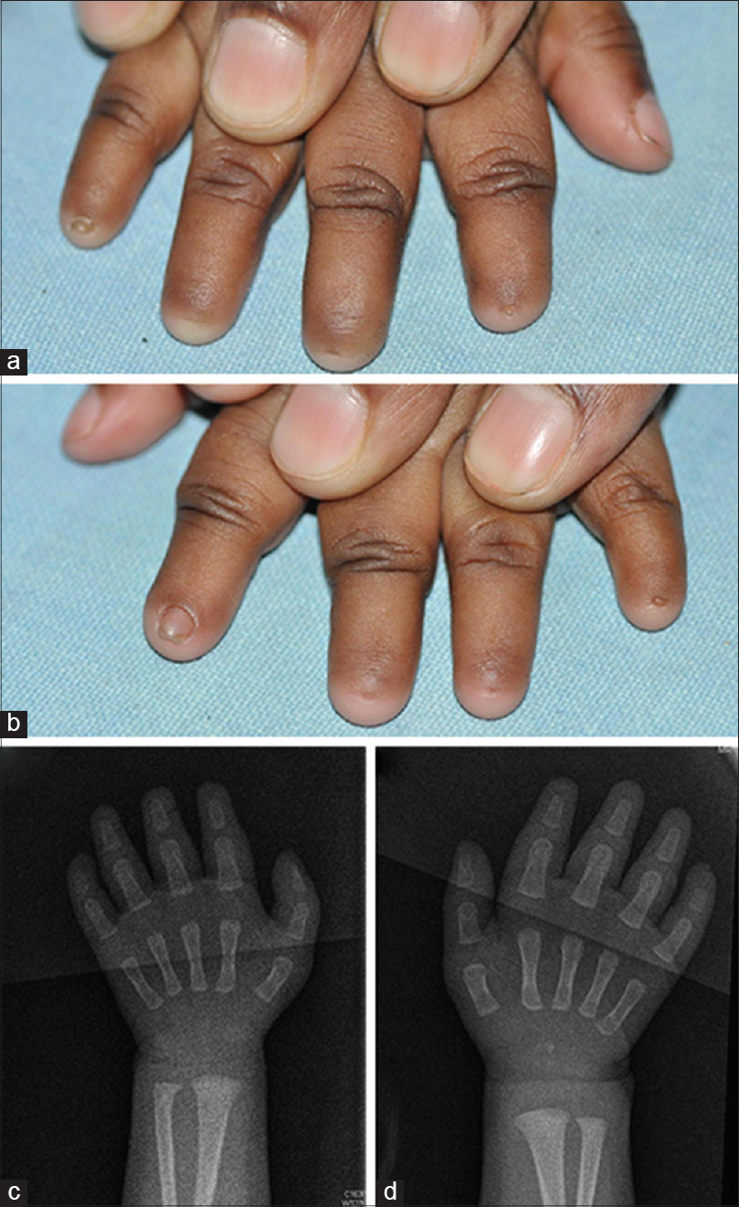 Photo showing the 28-year-old male with absence of all middle phalanges