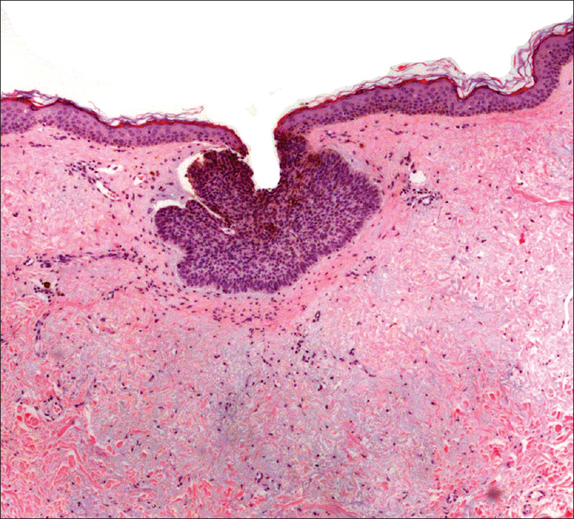 Linear Basal Cell Carcinoma Report Of Three Cases With Dermoscopic