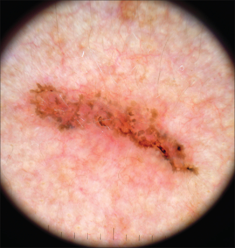 Linear Basal Cell Carcinoma Report Of Three Cases With Dermoscopic