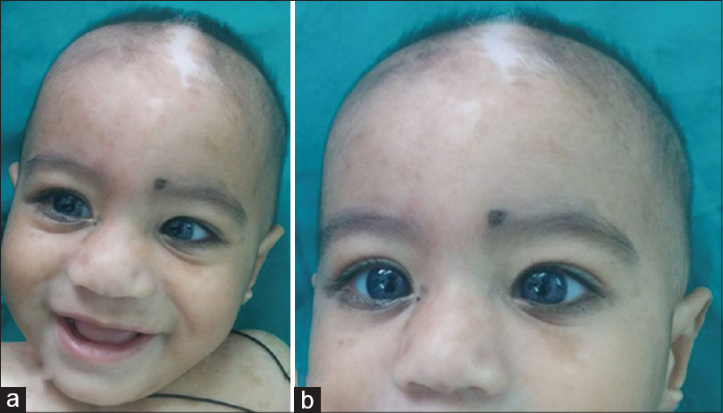 waardenburg syndrome skin