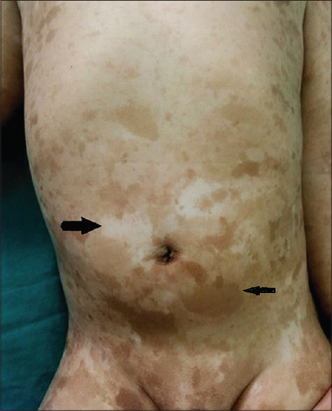 waardenburg syndrome skin