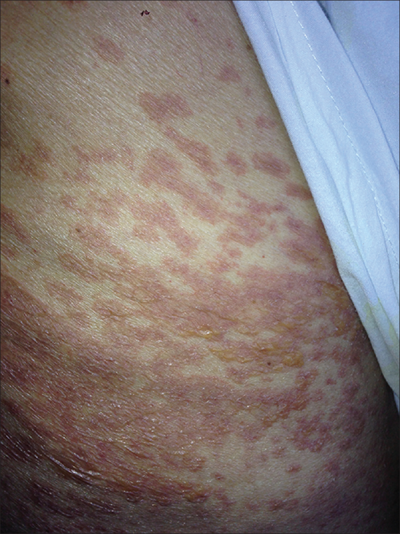 Linear Iga Bullous Dermatosis Due To Vancomycin And Cutaneous Necrosis