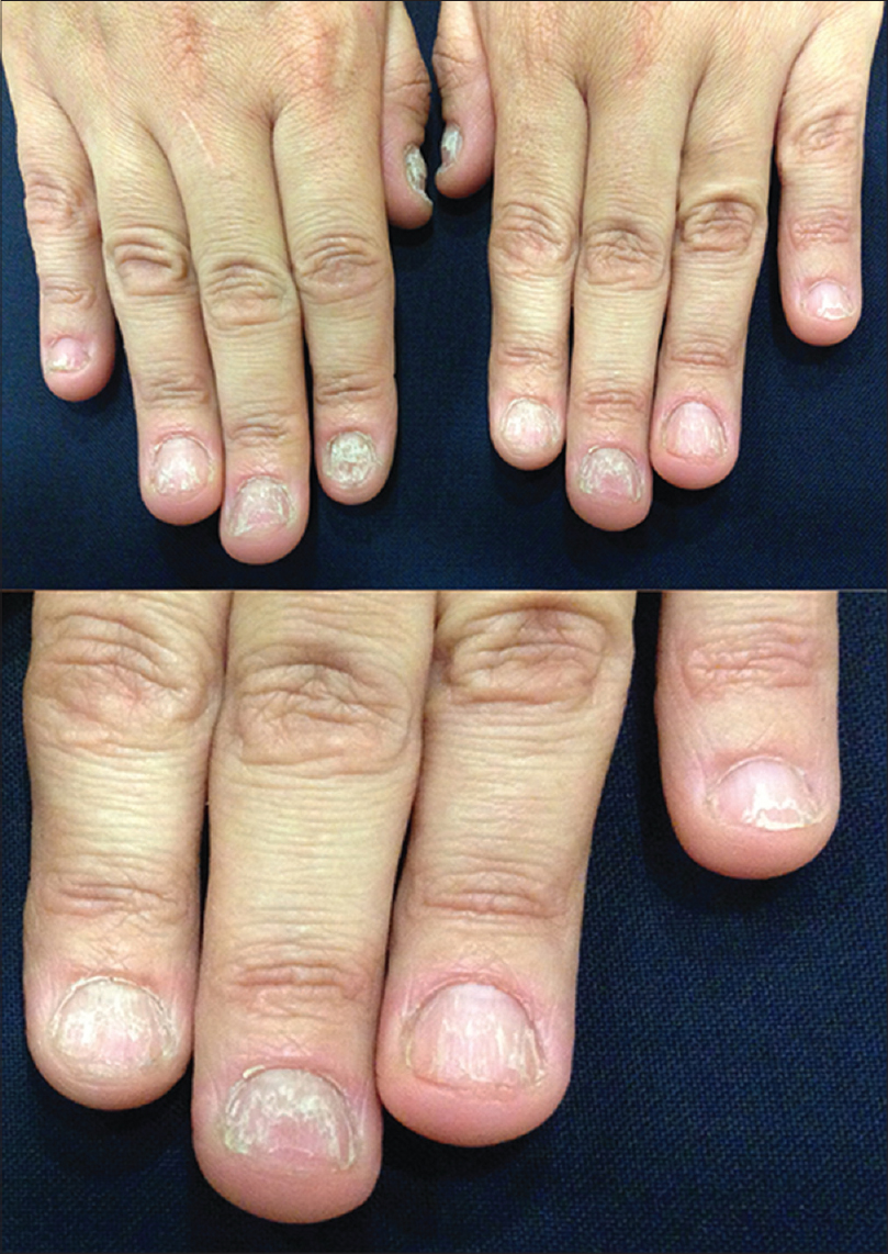 Figure 2 from Dermoscopy and Onychomycosis: guided nail abrasion for  mycological samples | Semantic Scholar