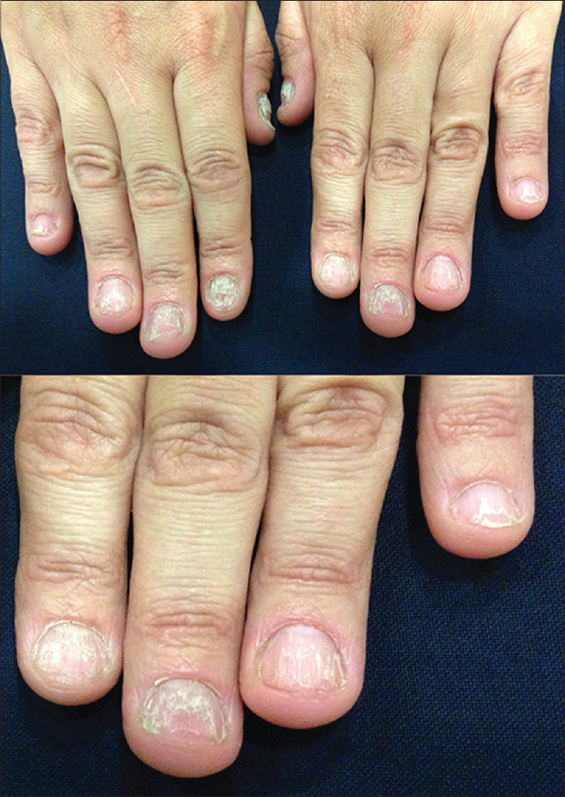 a–c) After 1 month of clobetasol propionate 0.05% ointment: Thick,... |  Download Scientific Diagram