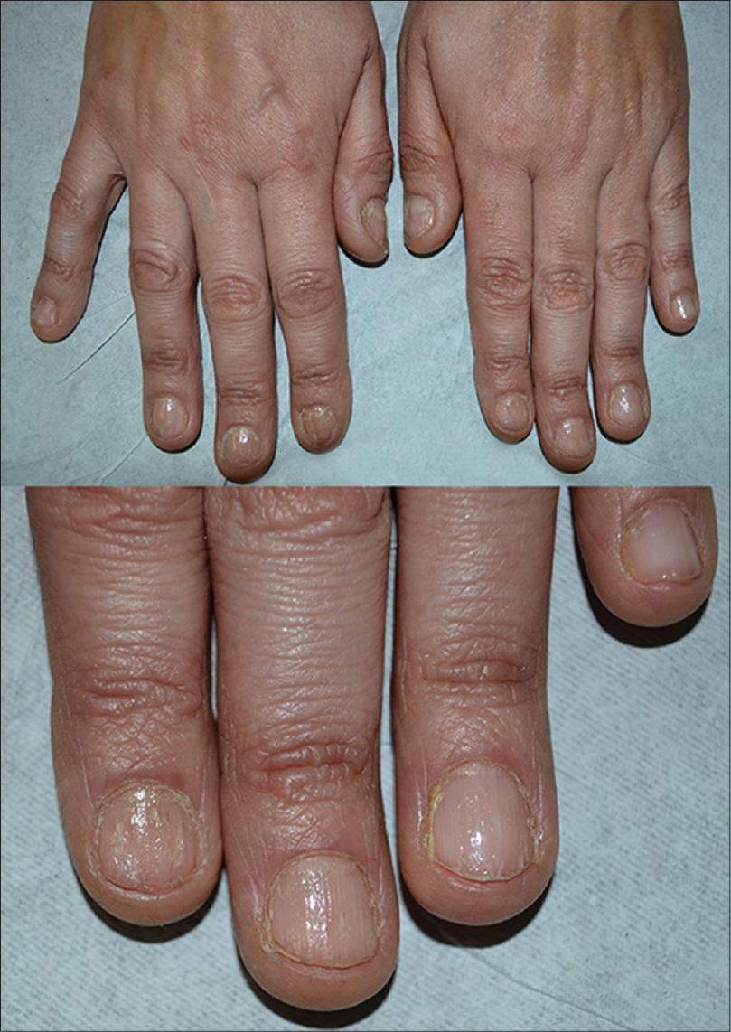 Nail Patterns in Papulosquamous Disorders- An Observational Study from  Southern India