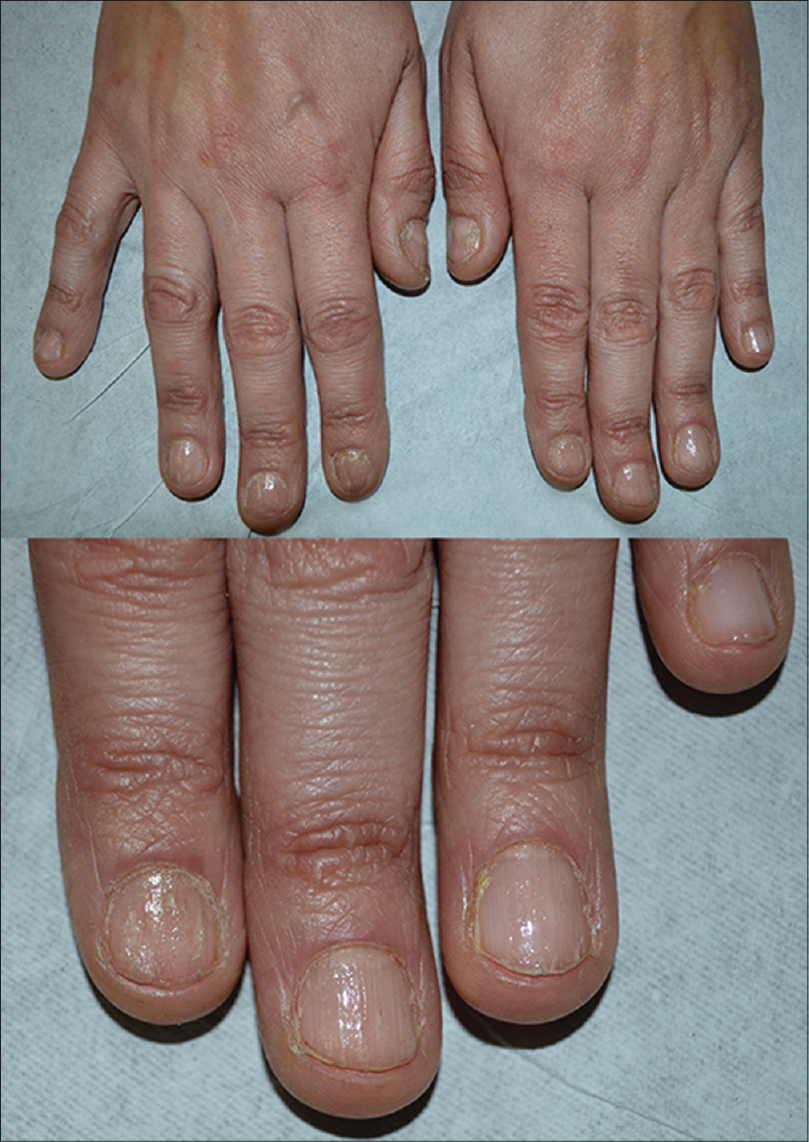 Nails in systemic disease | RCP Journals