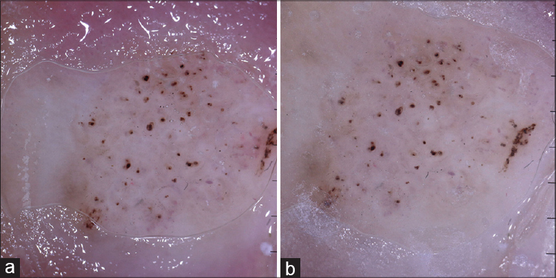 Indian Journal of Dermatology, Venereology and Leprology - Using