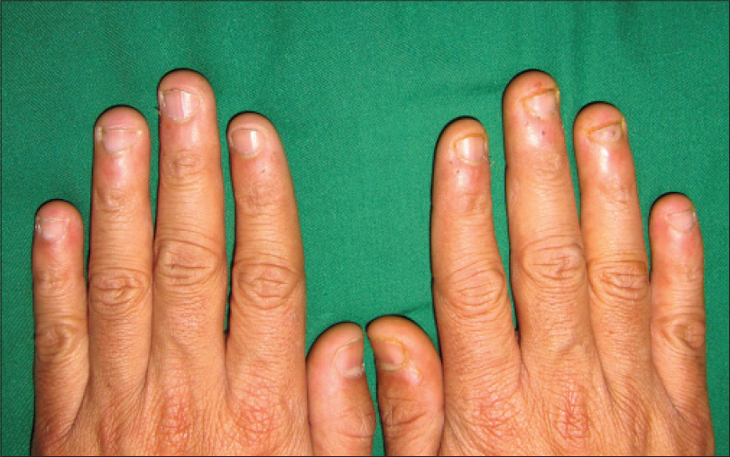 Premium Photo | Finger swollen with inflammation due to nail ripped  infection children's hands with a tear near the nail of the index finger  the consequence of biting your nails