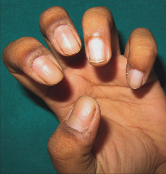 Nail tic disorders: Manifestations, pathogenesis and management - Indian  Journal of Dermatology, Venereology and Leprology