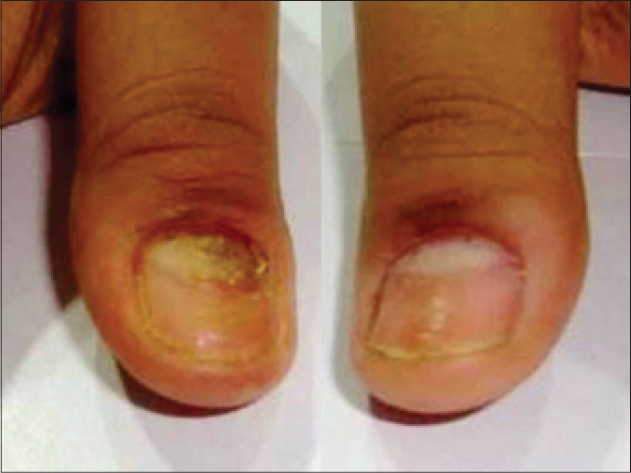 Do You Often Pick The Skin Around Nails? You May Have Excoriation Or Skin  Picking Disorder? - Boldsky.com