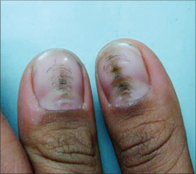 habit tic deformity