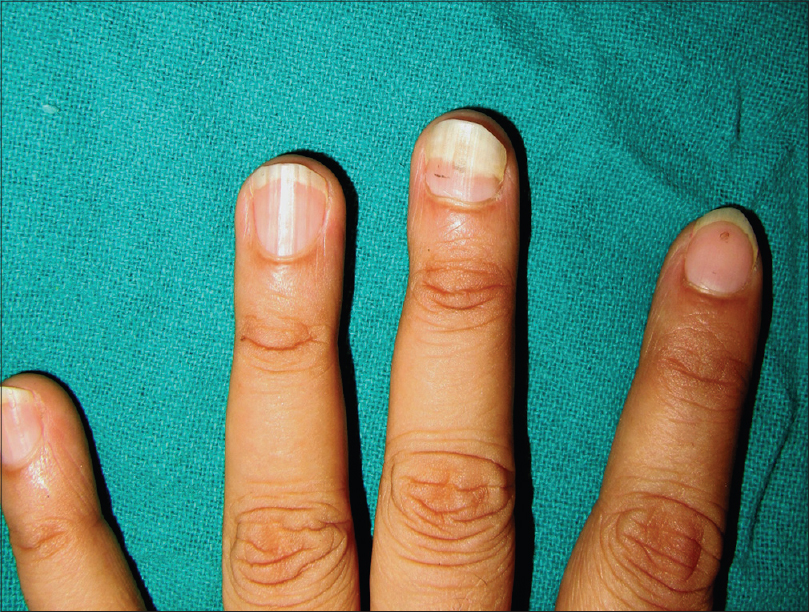 Green nail syndrome - Wikipedia
