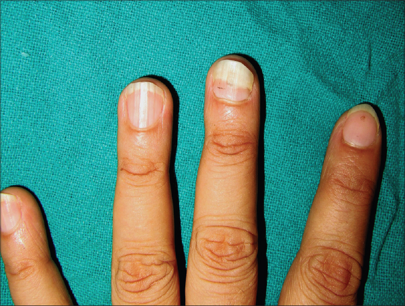 How to Stop Nail Biting: After 20 Years, This Is How I Finally Broke My  Biting Habit