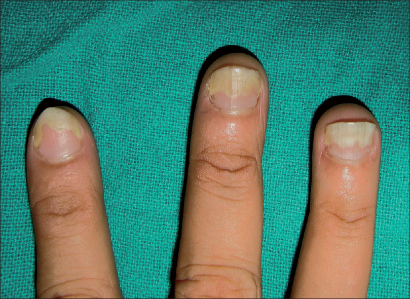 Why Are My Nails Separating? Everything You Need to Know About Onychol –  Dr. Dana