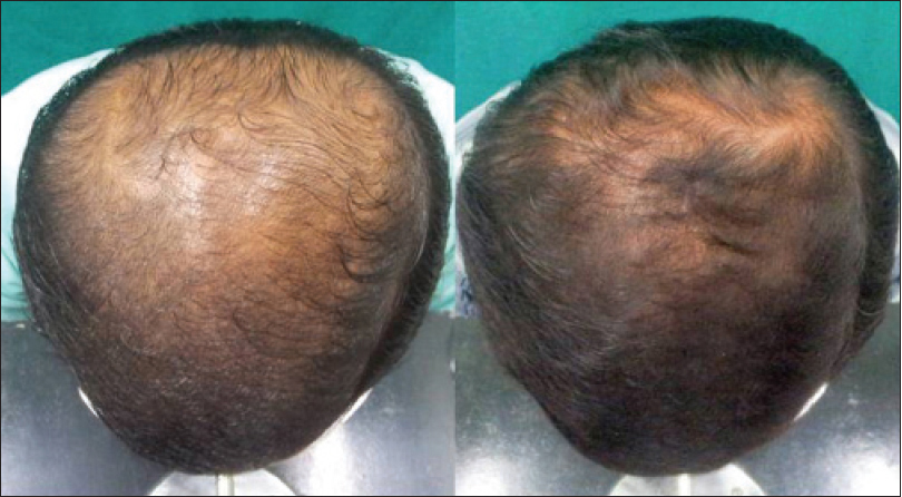 Male pattern baldness patient before and 24 weeks after taking Dutasteride for hair loss