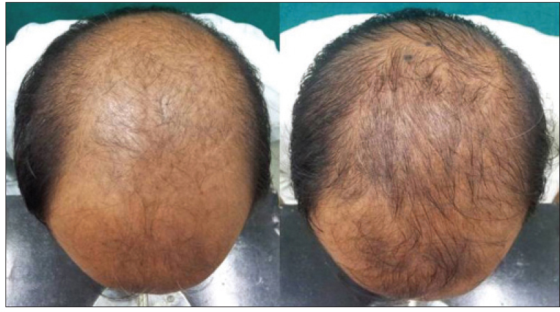 Superiority of dutasteride over finasteride in hair regrowth and reversal  of miniaturization in men with androgenetic alopecia: A randomized  controlled open-label, evaluator-blinded study - Indian Journal of  Dermatology, Venereology and Leprology