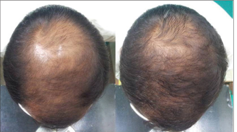 Before and after results of using Dutasteride for hair regrowth