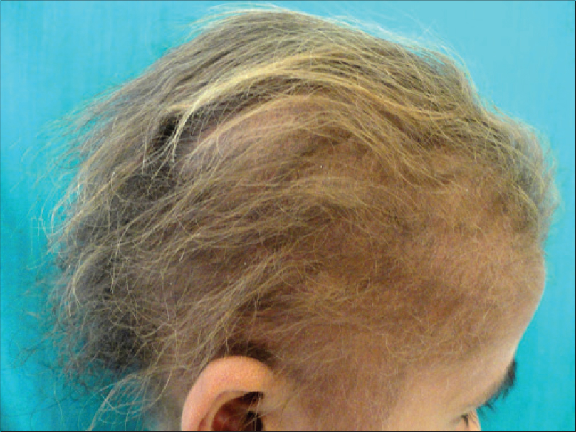 Uncombable hair syndrome with a woolly hair nevus - Indian Journal of  Dermatology, Venereology and Leprology
