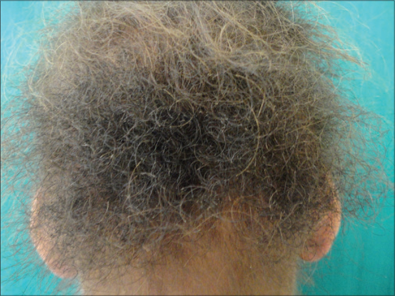 Uncombable hair syndrome with a woolly hair nevus - Indian Journal of  Dermatology, Venereology and Leprology