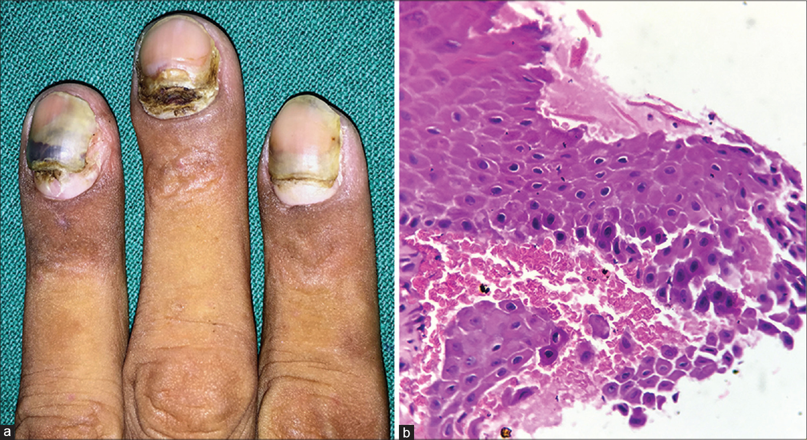 Radiographic Changes of Osteomyelitis in a Patient With Periungual Lichen  Planus | MDedge Dermatology