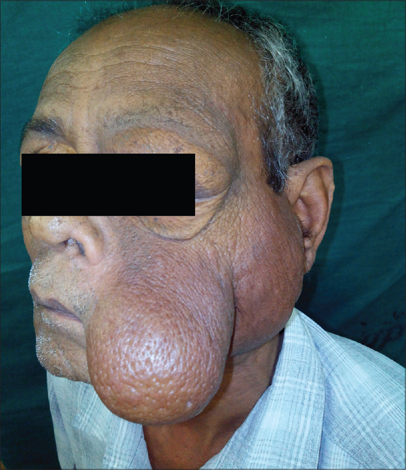 Low-dose cyclosporine for rapid remission and maintenance in recurrent  Kimura's disease - Indian Journal of Dermatology, Venereology and Leprology
