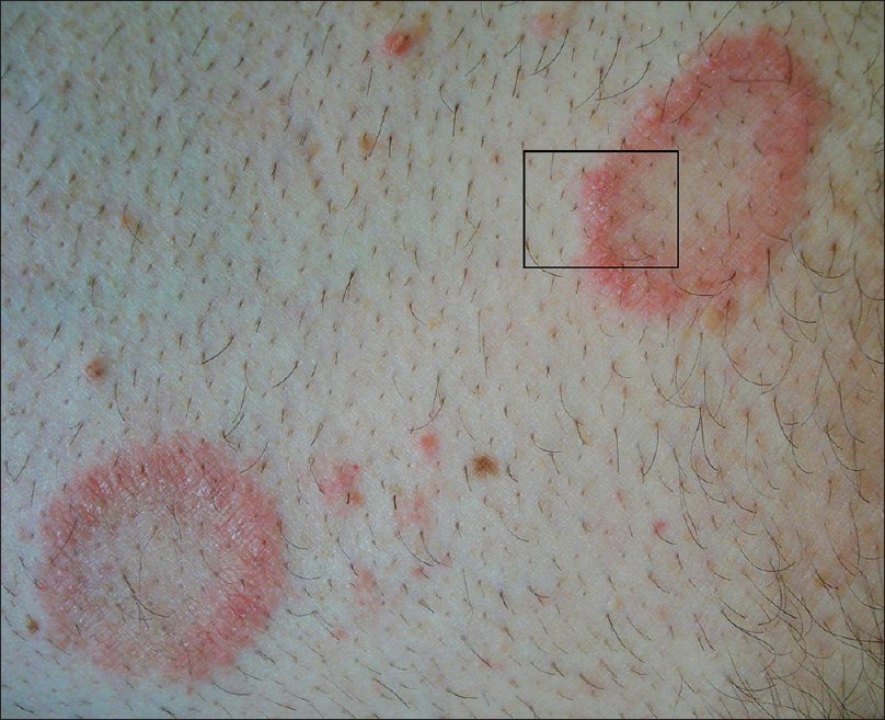 Diffuse annular lesions