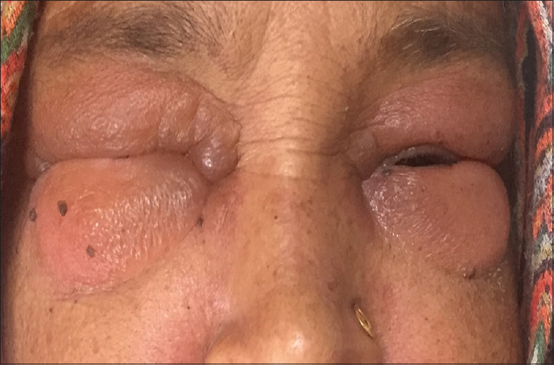 periorbital edema dermatomyositis