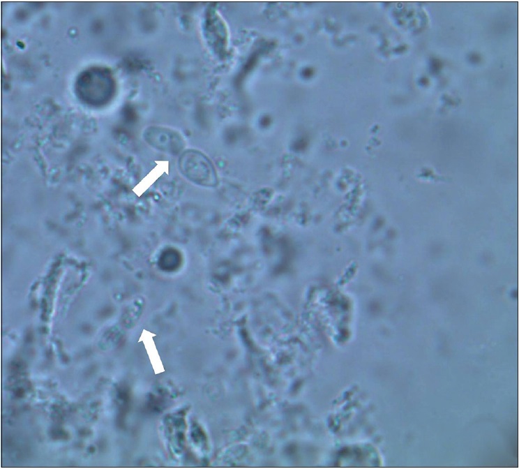 Trichosporon inkin causing subcutaneous sinus tract: Successfully ...