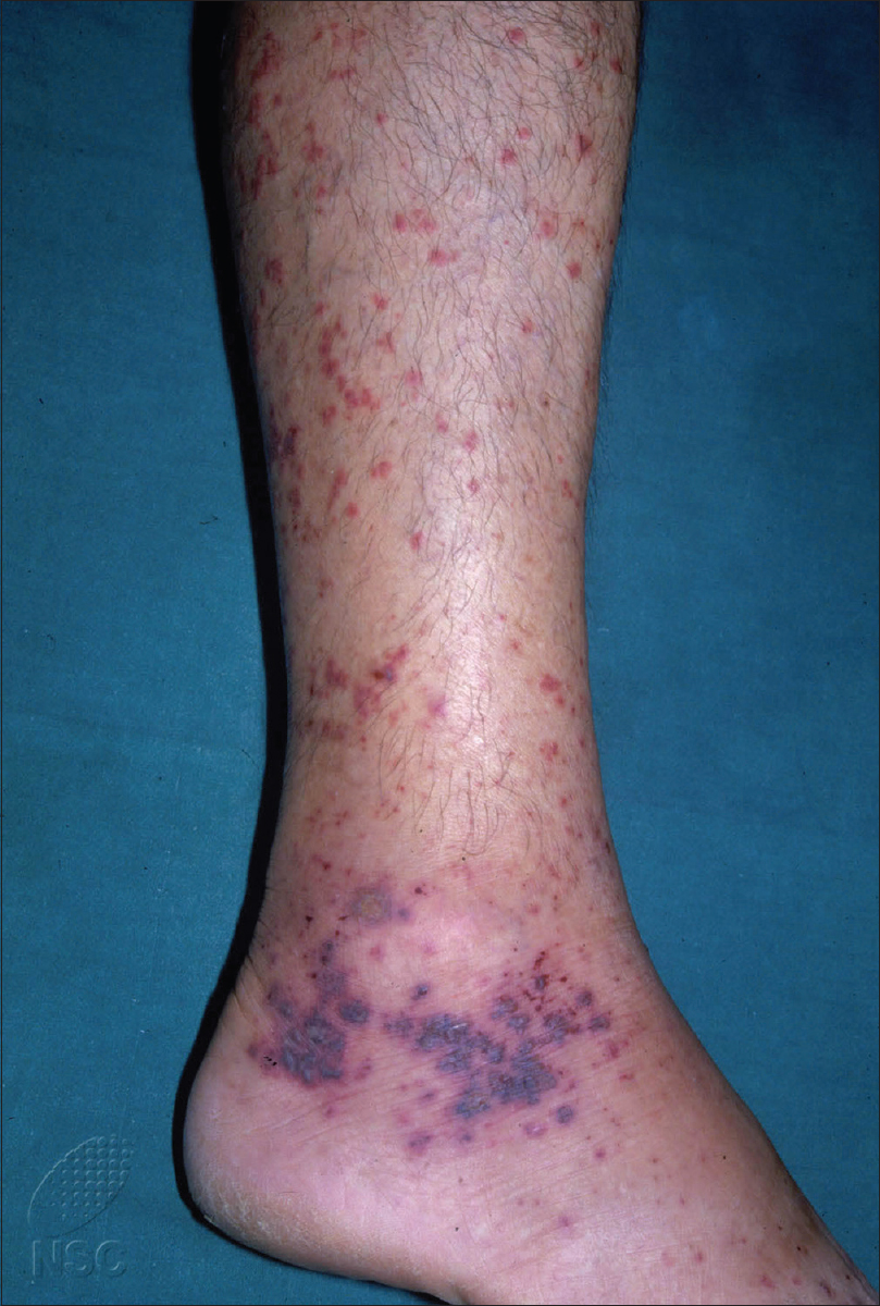Indian Journal Of Dermatology Venereology And Leprology Adult Henoch Schonlein Purpura Clinical And Histopathological Predictors Of Systemic Disease And Profound Renal Disease