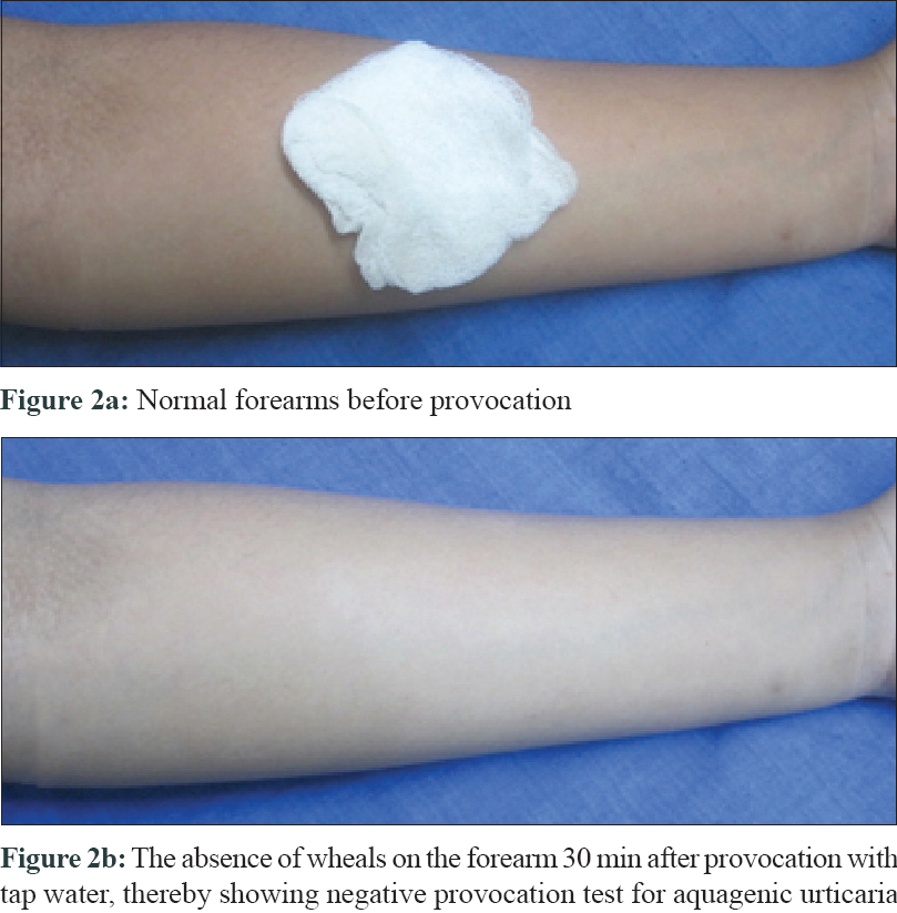 Aquagenic Urticaria Causes, Diagnosis, Facts And Treatment, 42 OFF