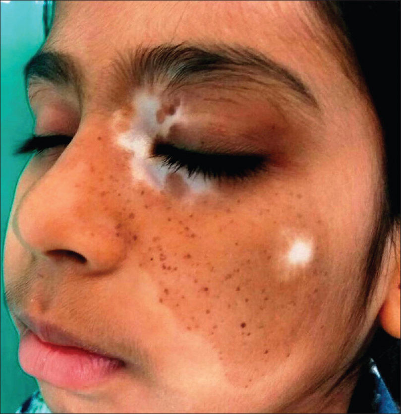 Epidermal Nevus Syndromes, 50% OFF | micoope.com.gt