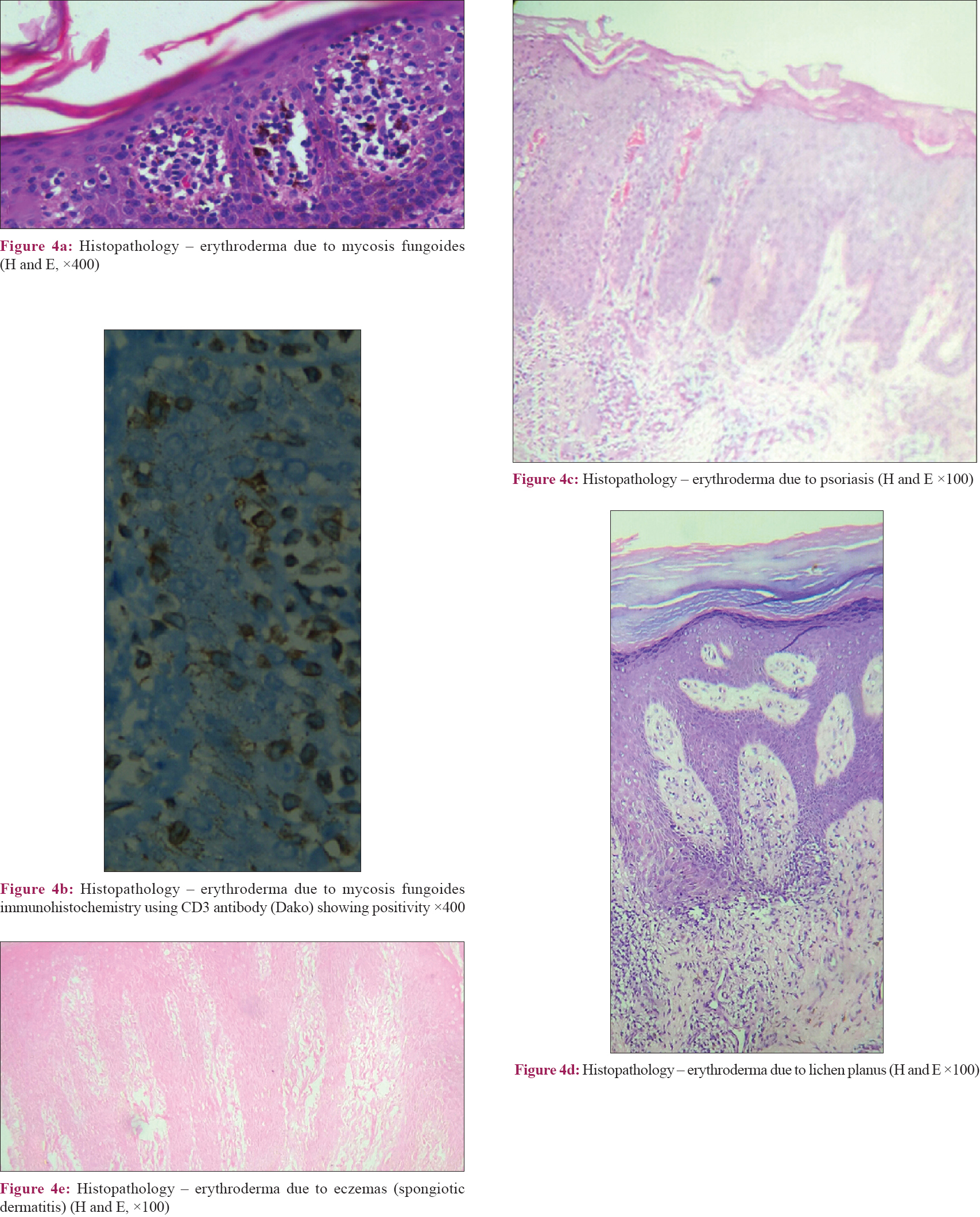 Erythrodermic Psoriasis Histology