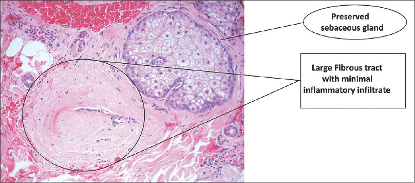 scarring alopecia histology