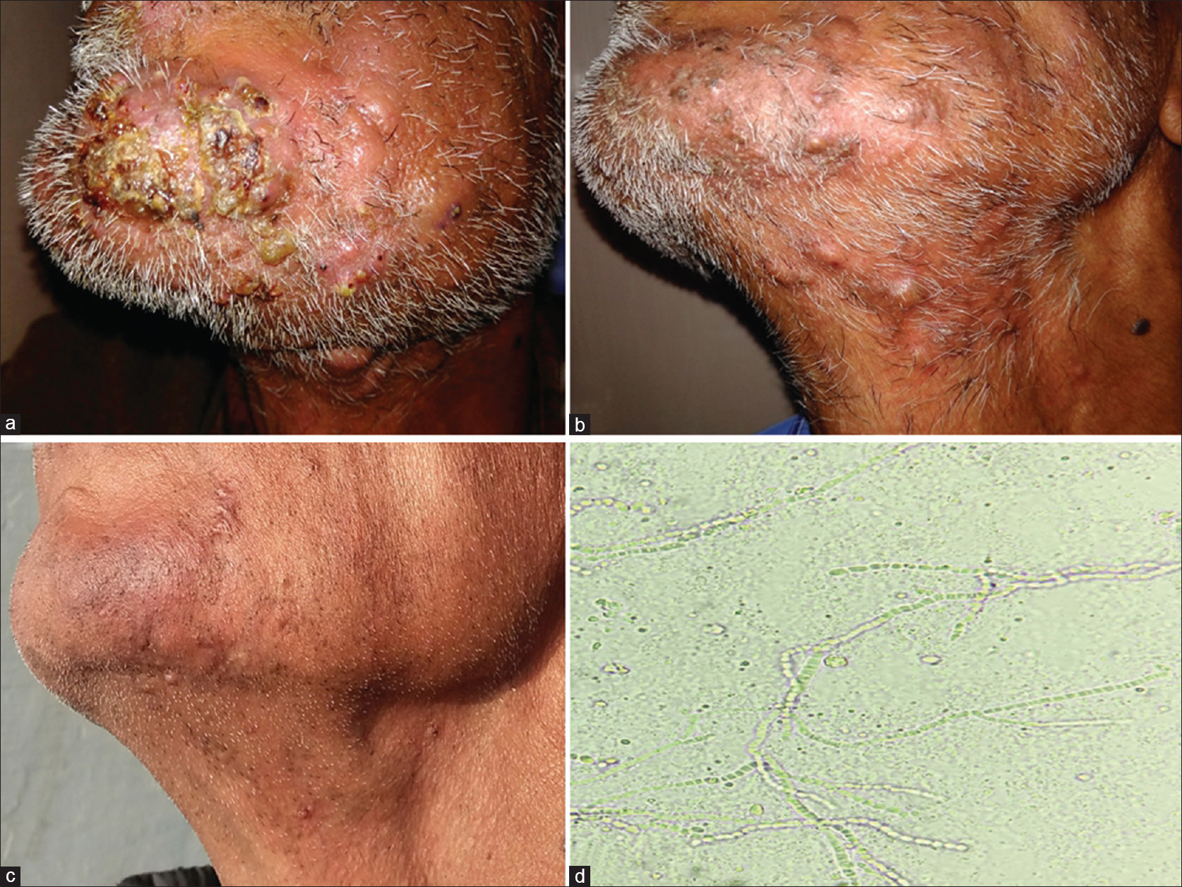 Sycosiform tinea barbae caused by