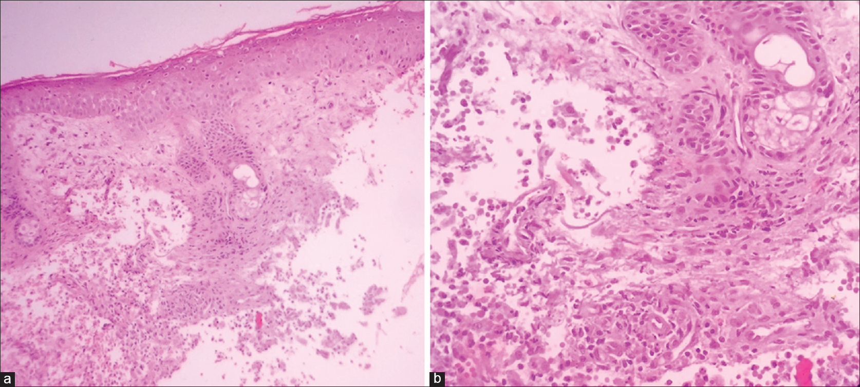 Tinea barbae presenting as kerion - Indian Journal of Dermatology