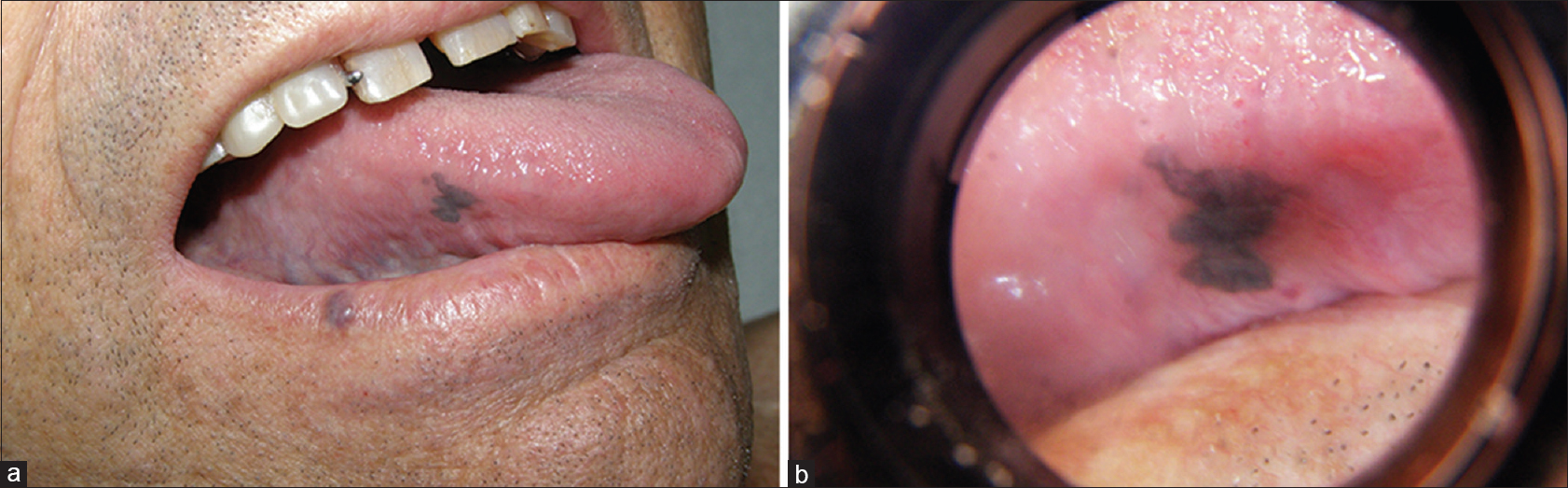 oral malignant melanoma