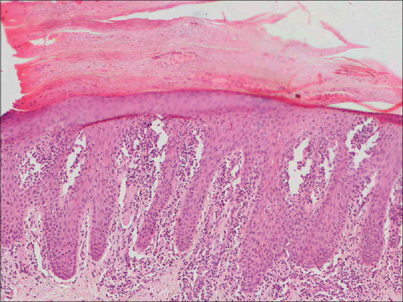 palmoplantar pustular psoriasis histology)