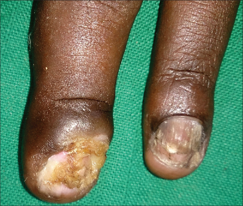 Practical Pearls in Cutaneous Fungal Infections and Onychomycosis