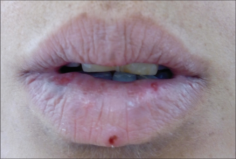 Lesions On Lips