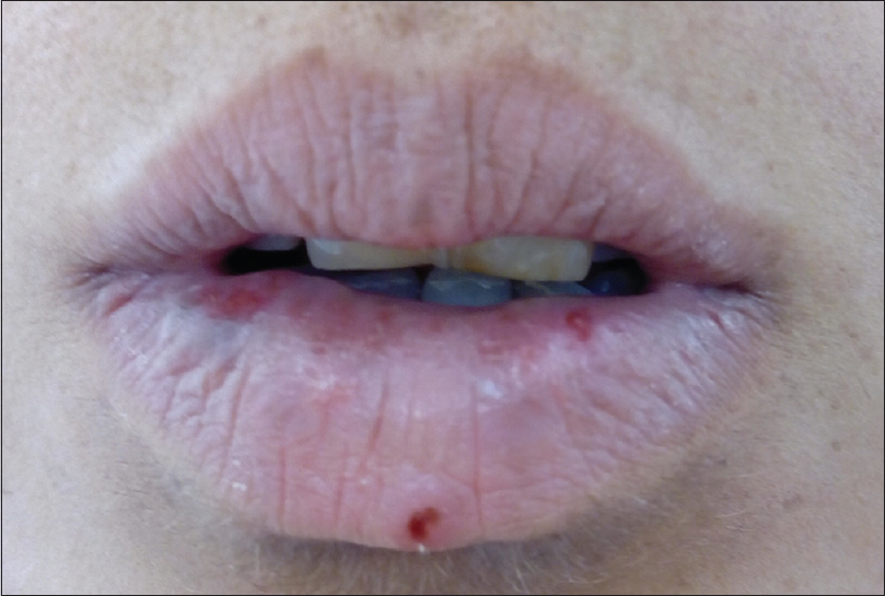 Purple Spot On Lower Lip - Infoupdate.org