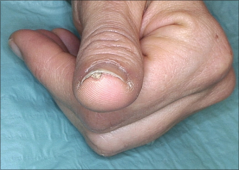 Indian Journal Of Dermatology Venereology And Leprology An Annoying Mass Of The Nail Bed