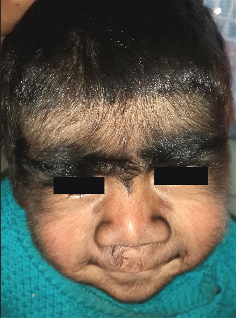 congenital hypertrichosis