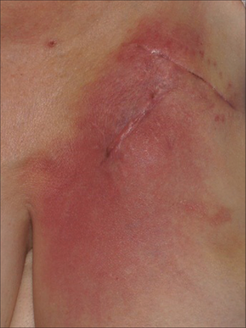 implantable cardioverter defibrillator scar