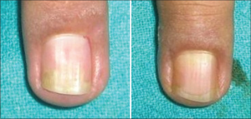 steroid injection for nail psoriasis