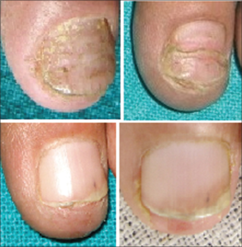 corticosteroids for nail psoriasis