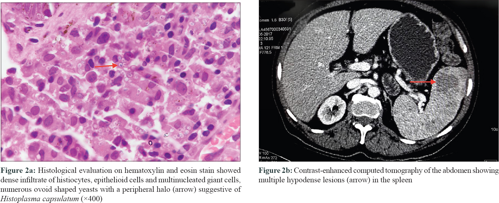 Primary cutaneous histoplasmosis in an immunocompetent patient ...