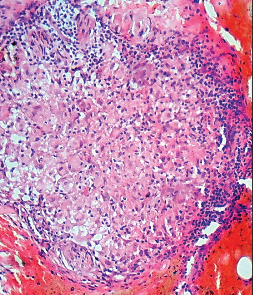 Metronidazole as a monotherapy in the management of granulomatous ...