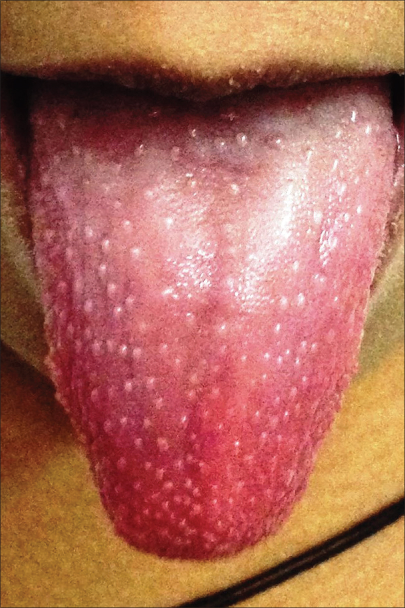 strawberry tongue