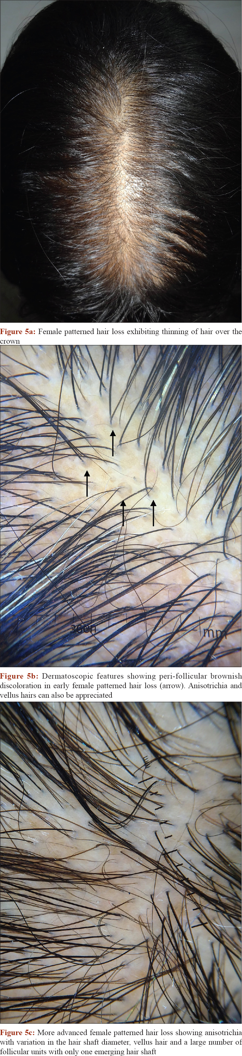 Approach to inherited hypertrichosis: A brief review - Indian Journal of  Dermatology, Venereology and Leprology