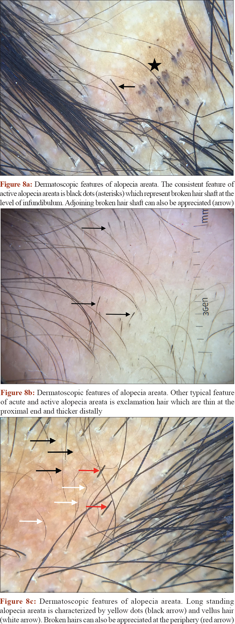 Approach to inherited hypertrichosis: A brief review - Indian